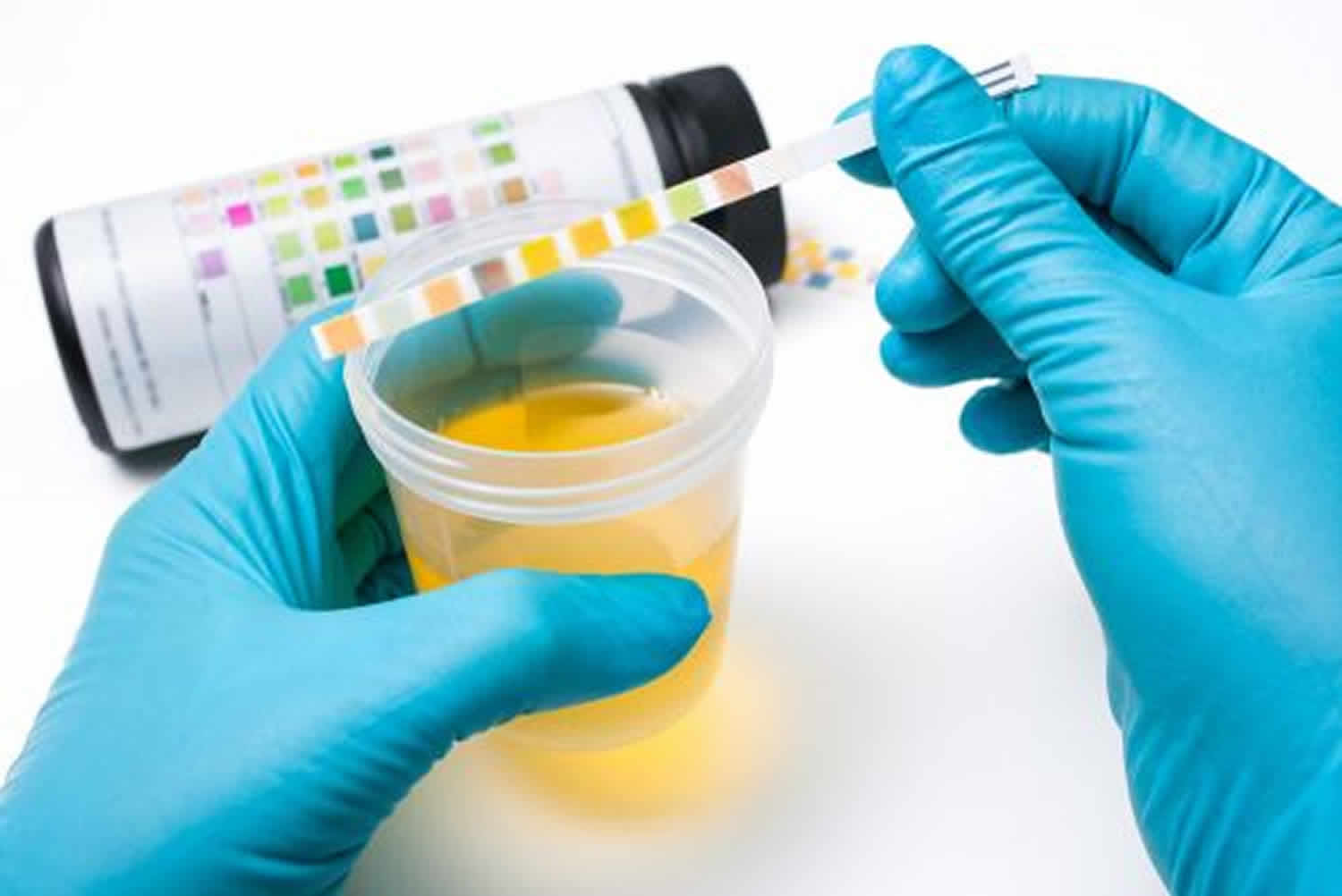 Urine Sodium Test Urine Sodium Interpretation Urine Sodium 