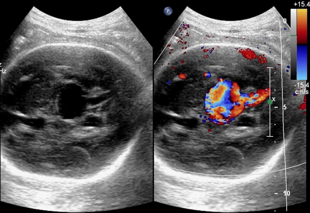 Vein Of Galen Aneurysm Fetal Ultrasound