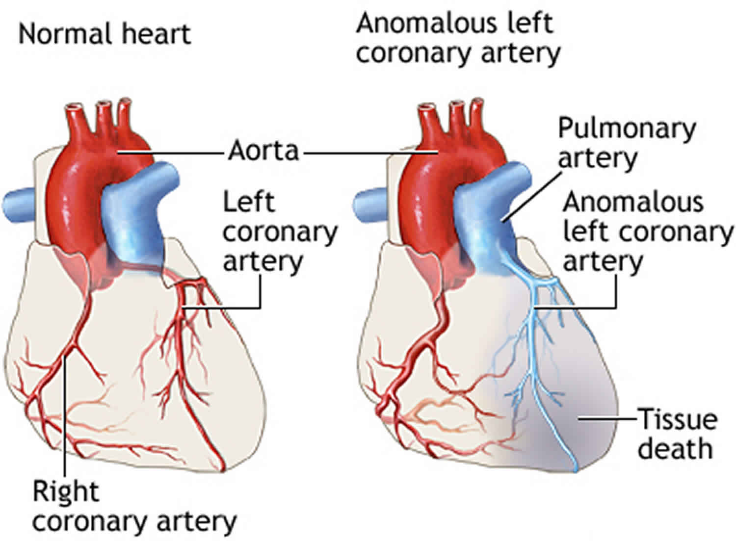 ALCAPA Anomalous Left Coronary Artery Causes Symptoms Diagnosis 