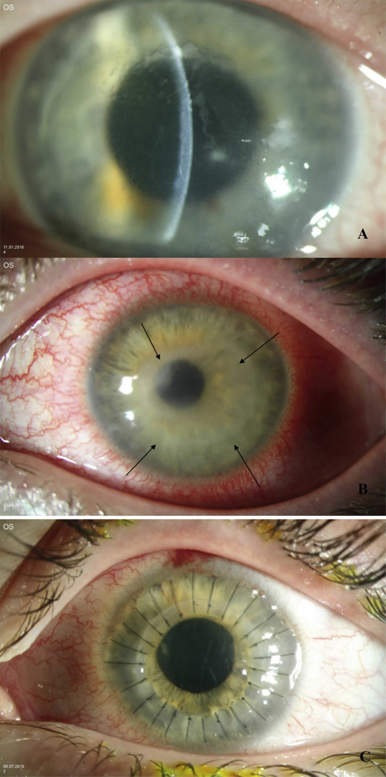 Acanthamoeba Keratitis Causes, Signs, Symptoms, Diagnosis, Treatment ...