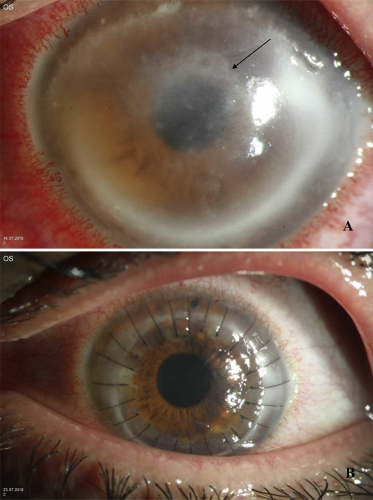 Acanthamoeba Keratitis Causes Signs Symptoms Diagnosis Treatment And Prognosis 7323