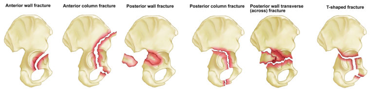 Acetabular Fracture Causes Symptoms Diagnosis Treatment And Prognosis