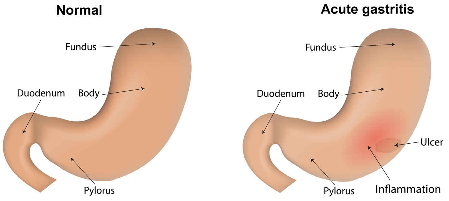 Non Erosive Gastritis Nhs