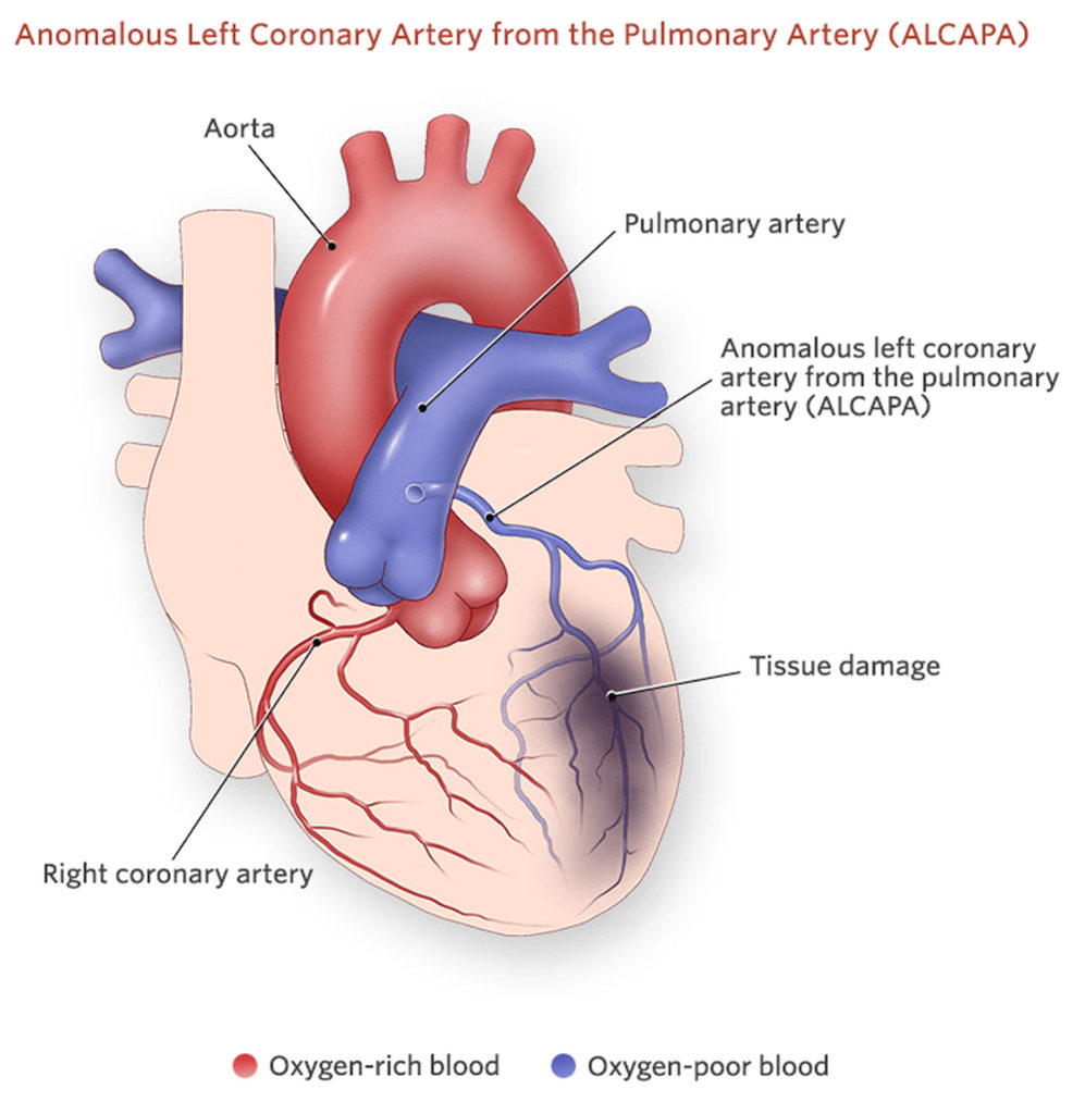 Anomalous coronary artery types, symptoms, diagnosis & treatment