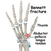 Bennett fracture