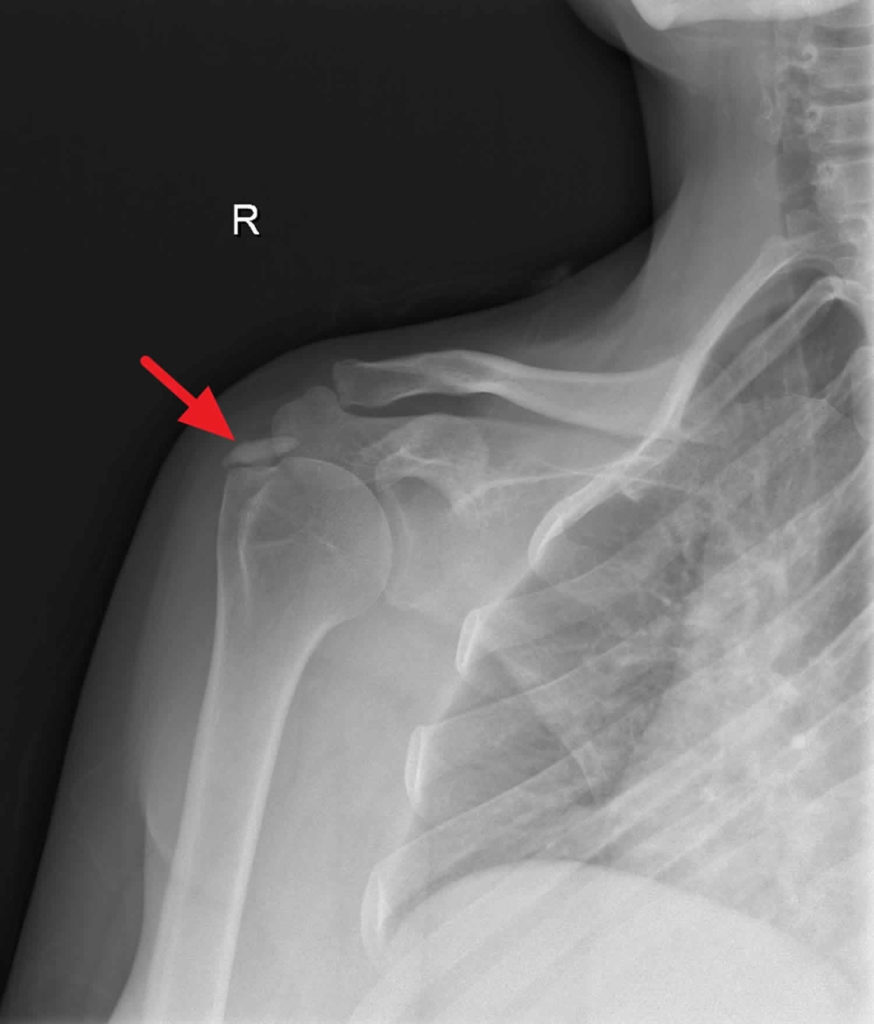 Calcific tendinosis causes, symptoms, diagnosis, treatment & prognosis