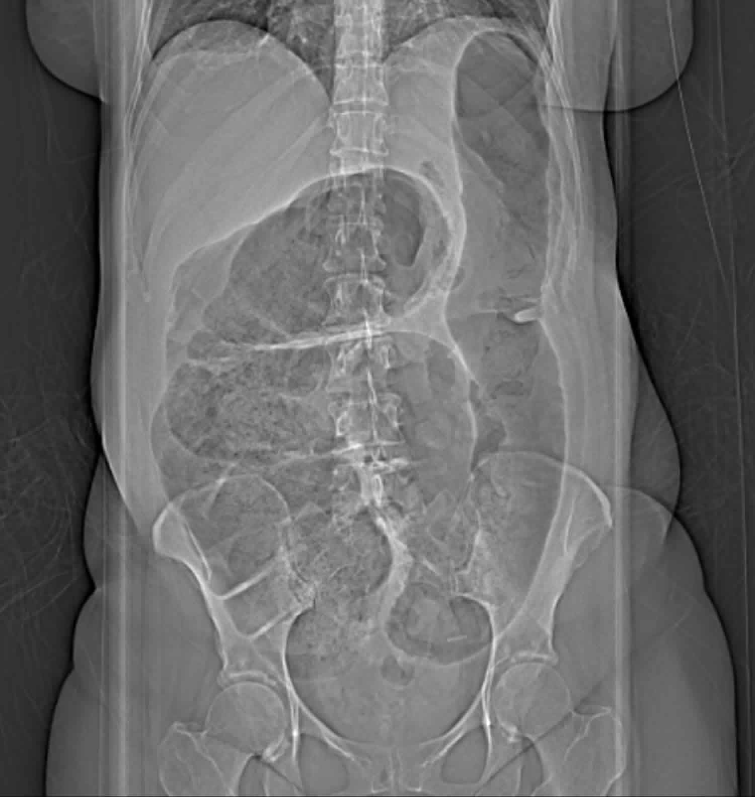 Cecal volvulus abdominal X-ray