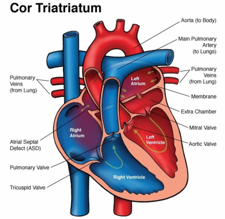 Cor triatriatum causes, symptoms, diagnosis, treatment & prognosis