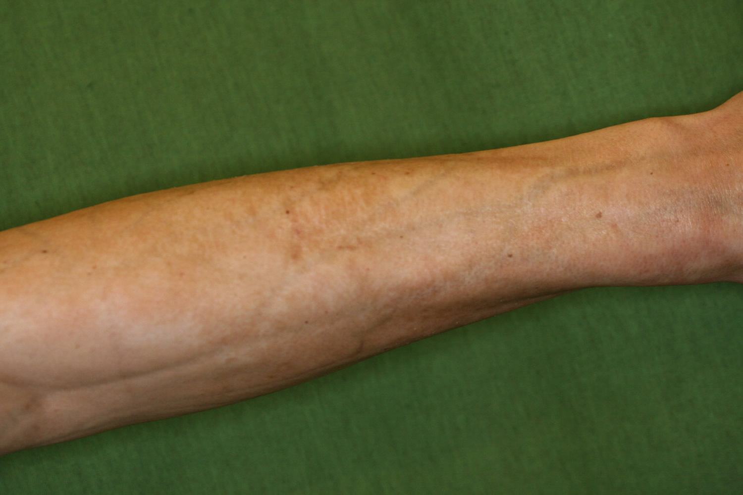 Eosinophilic Fasciitis Groove Sign