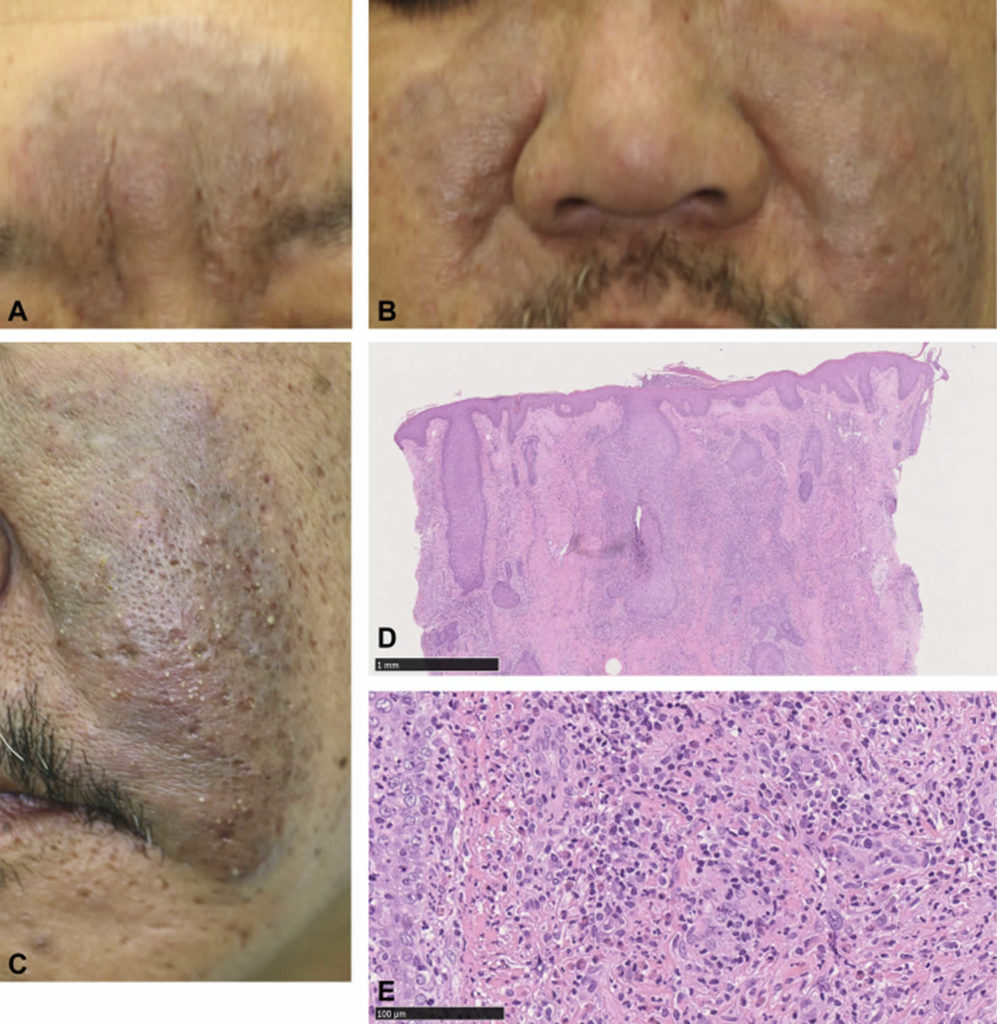 Eosinophilic folliculitis causes, symptoms, diagnosis, treatment ...