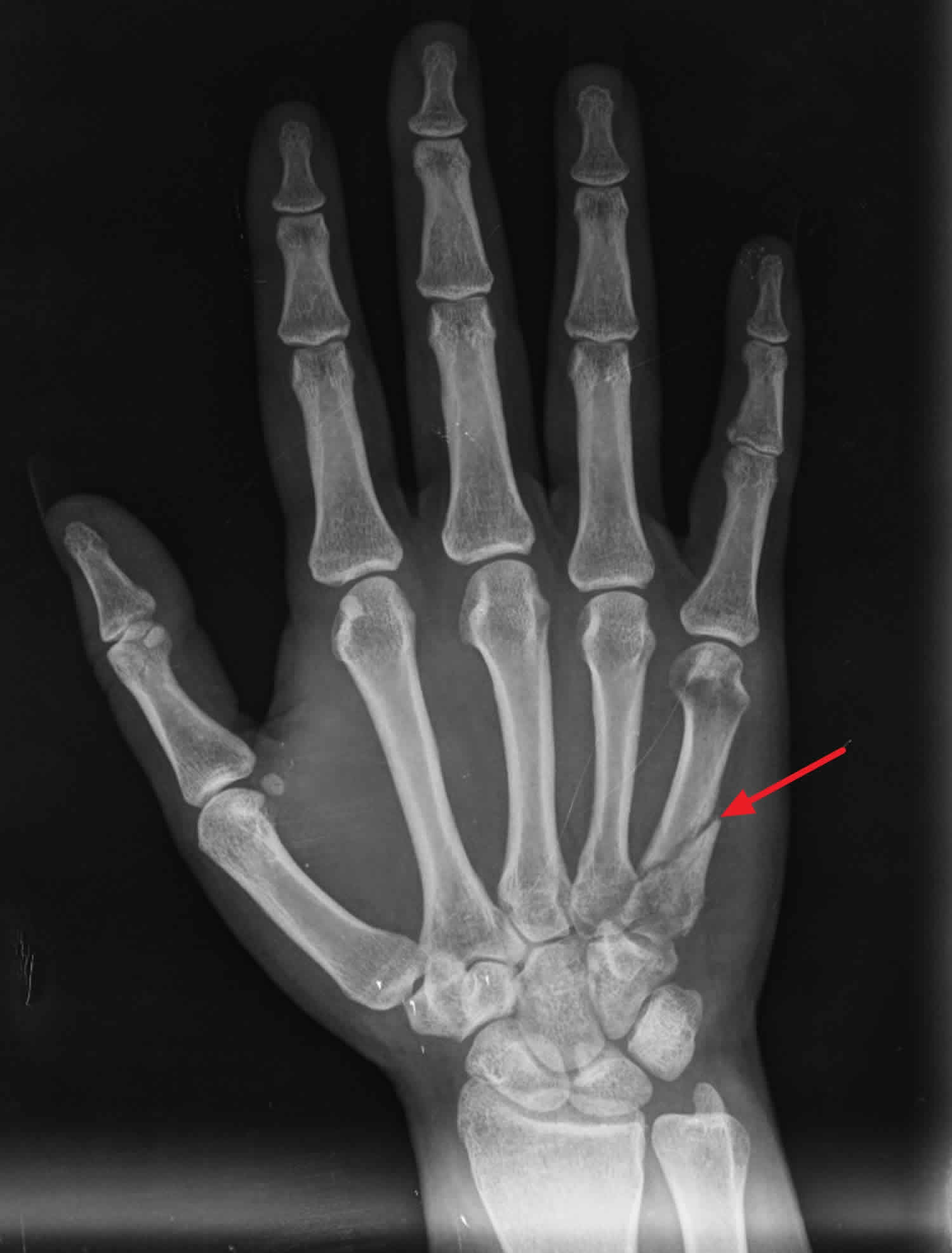 comminuted fracture hand
