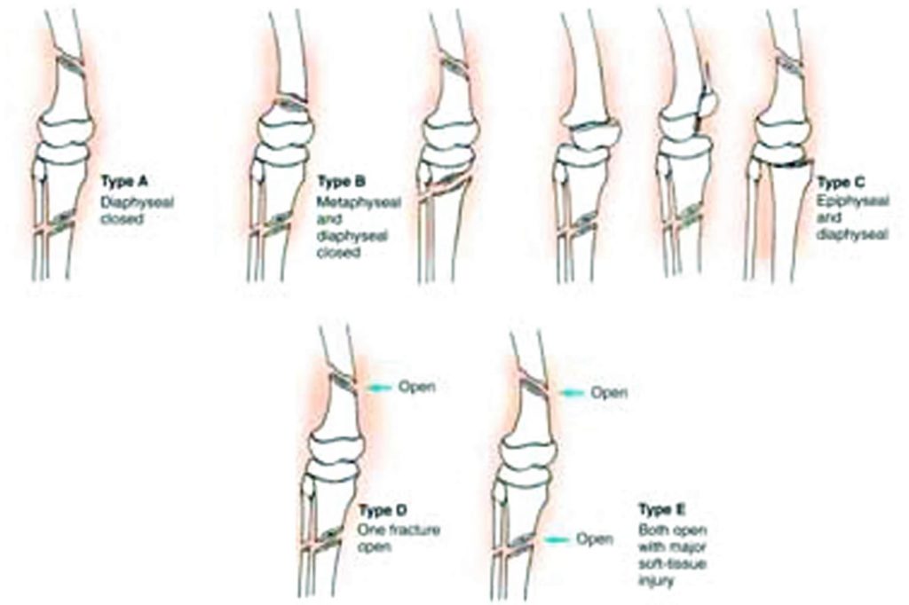 Floating knee definition, causes, symptoms, diagnosis, treatment