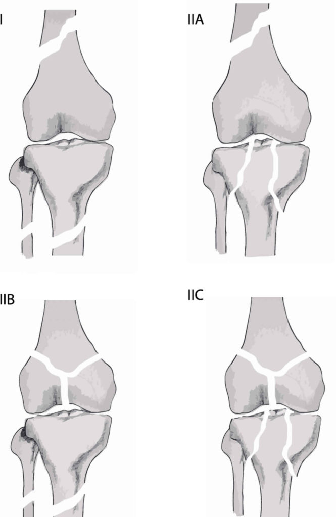 Floating Knee Definition, Causes, Symptoms, Diagnosis, Treatment ...