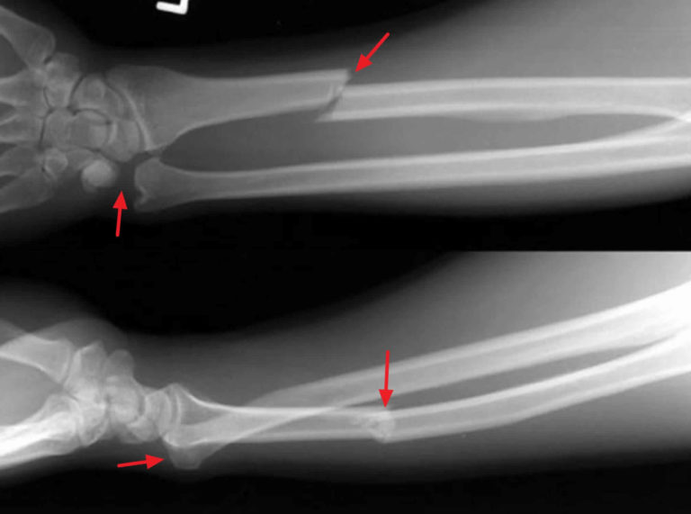 therapy galeazzi fracture
