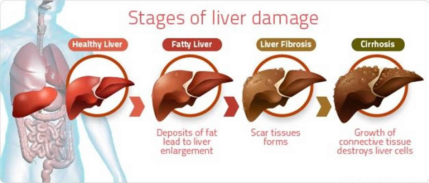 fatty-liver-disease