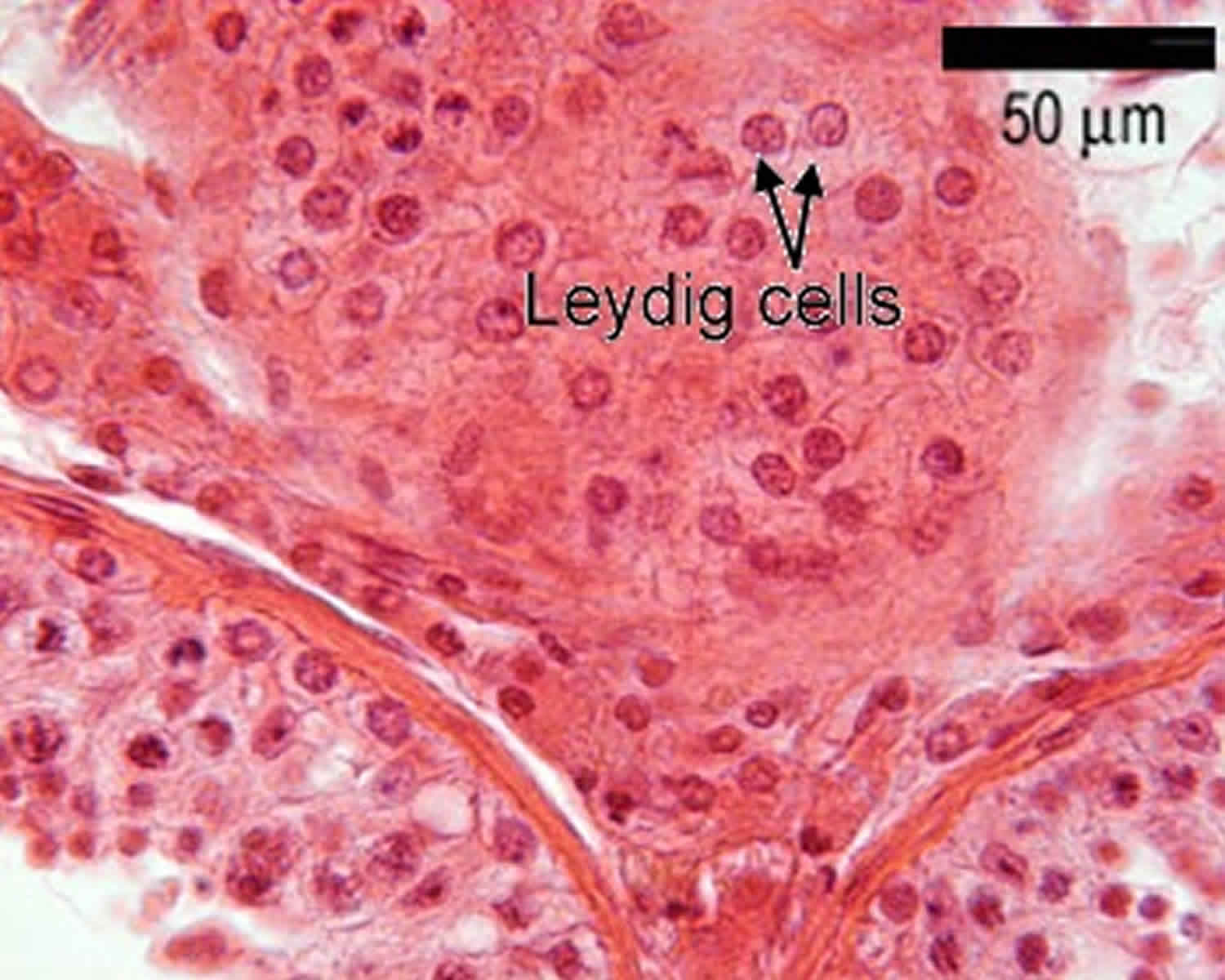 Leydig Cell Tumor Causes Symptoms Diagnosis Treatment Prognosis