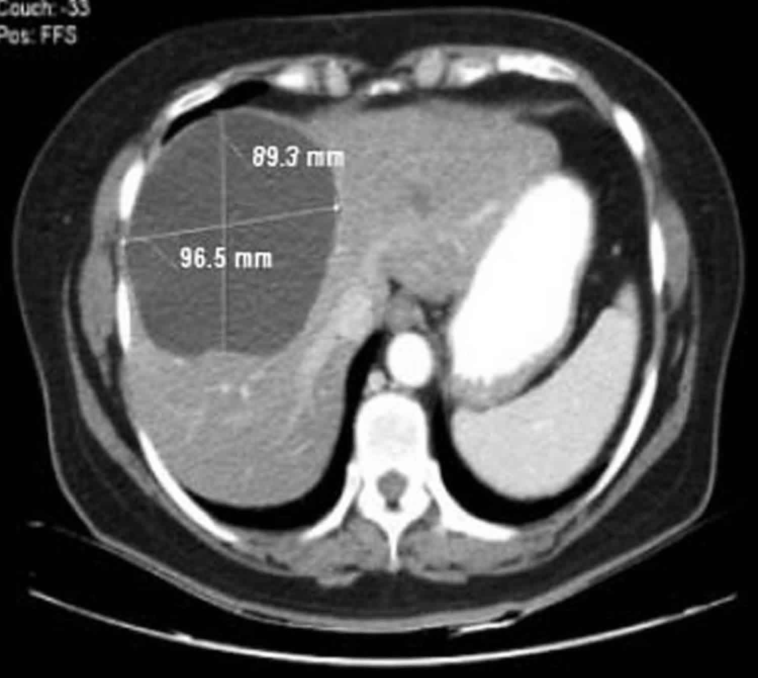 Benign Liver Tumors And Hepatic Cysts Knowledge AMBOSS 58 OFF