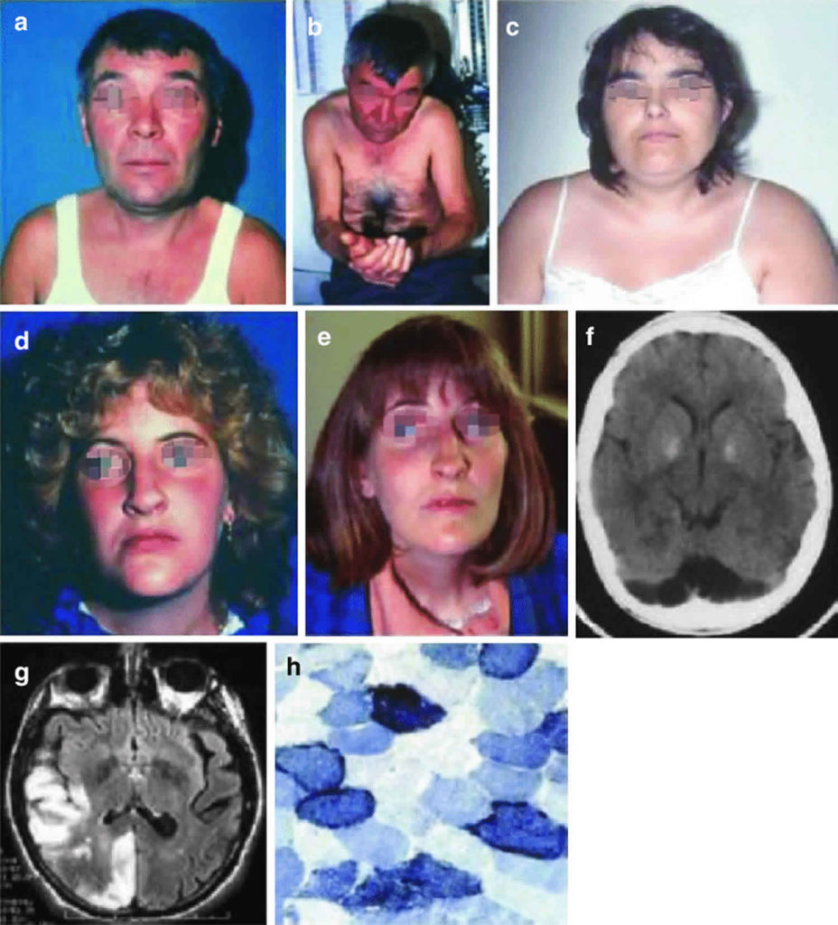 MELAS syndrome causes, symptoms, diagnosis, treatment & prognosis