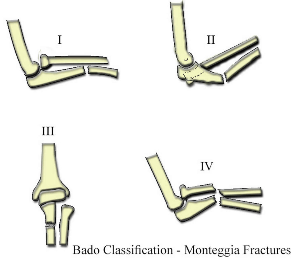 Monteggia Fracture Causes Types Symptoms Diagnosis Treatment And Prognosis 