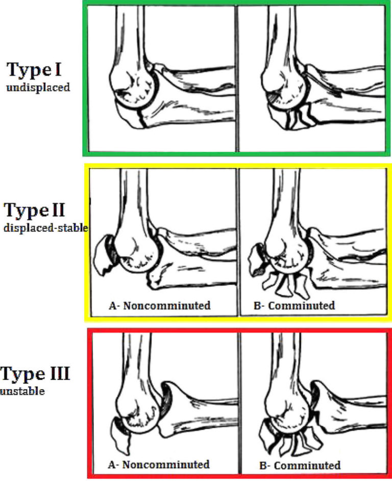 Olecranon Fracture Causes Symptoms Diagnosis Treatment And Prognosis 9769