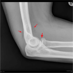 Radial head fracture causes, types, symptoms, diagnosis, treatment ...