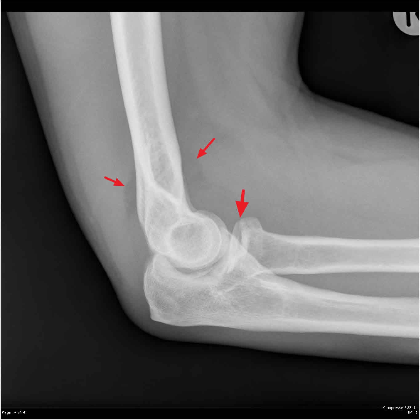 does radial head fracture cause wrist pain