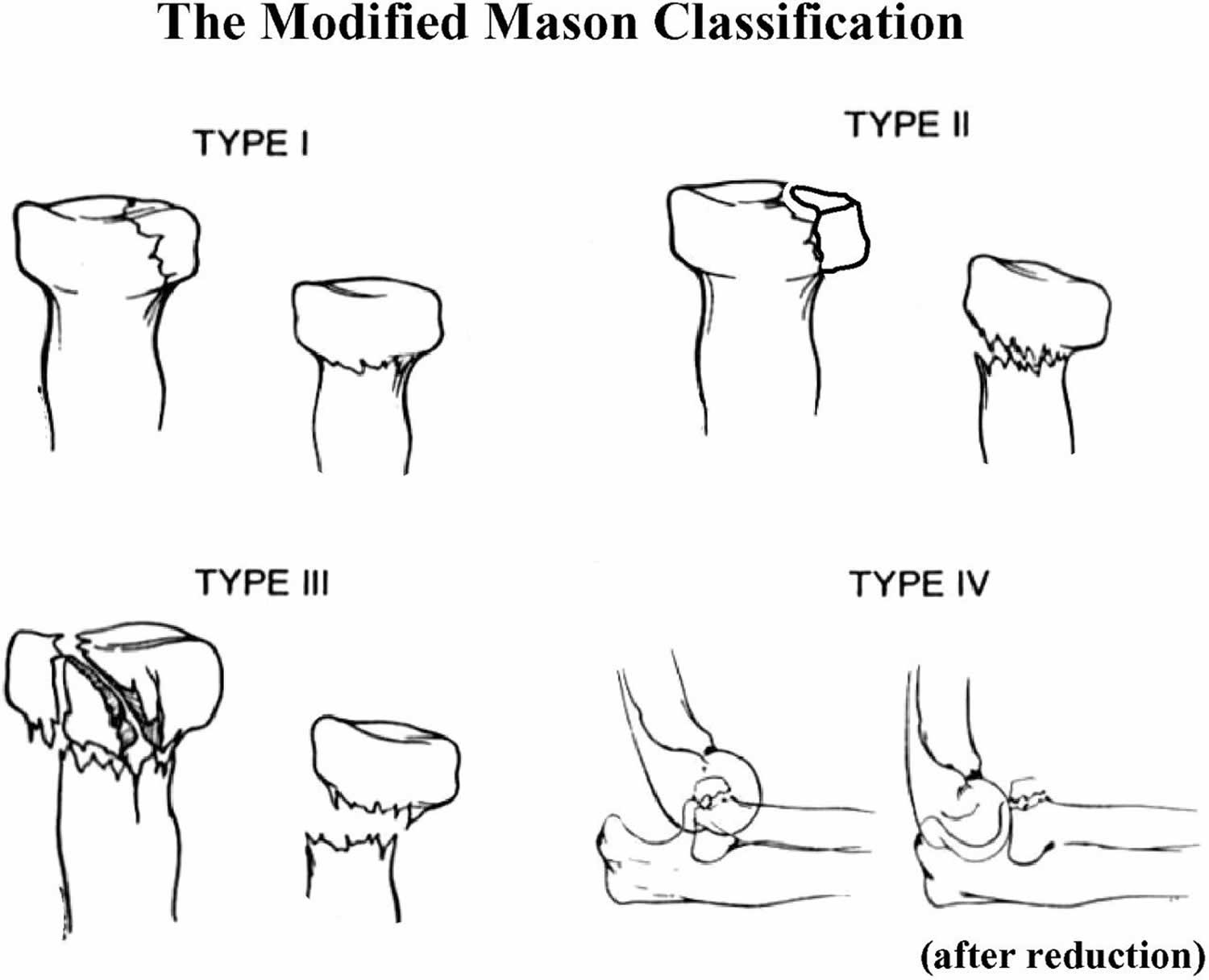 Mason Classification Radial Head