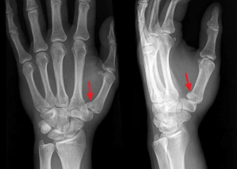 Rolando fracture causes, symptoms, diagnosis, treatment & recovery