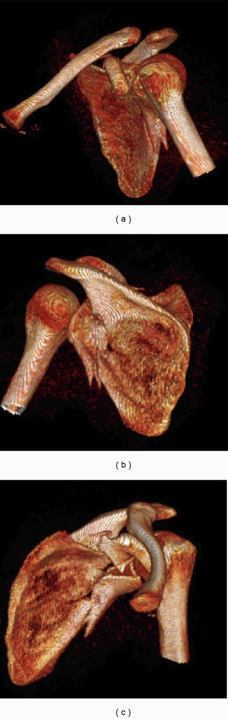 How Serious Is A Fractured Scapula