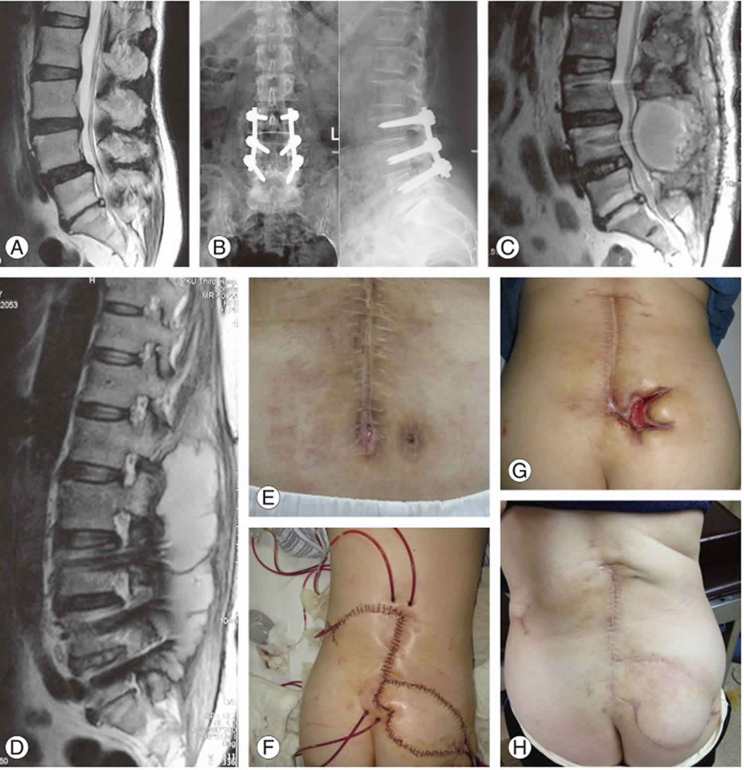 Spinal infection