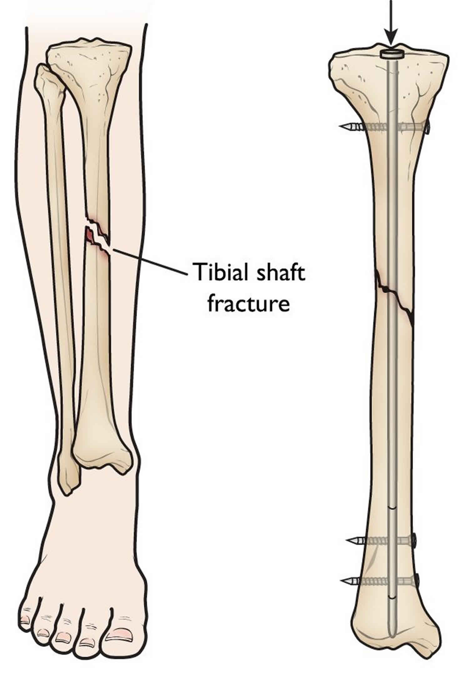 Tibial shaft fracture causes, types, symptoms, diagnosis ...