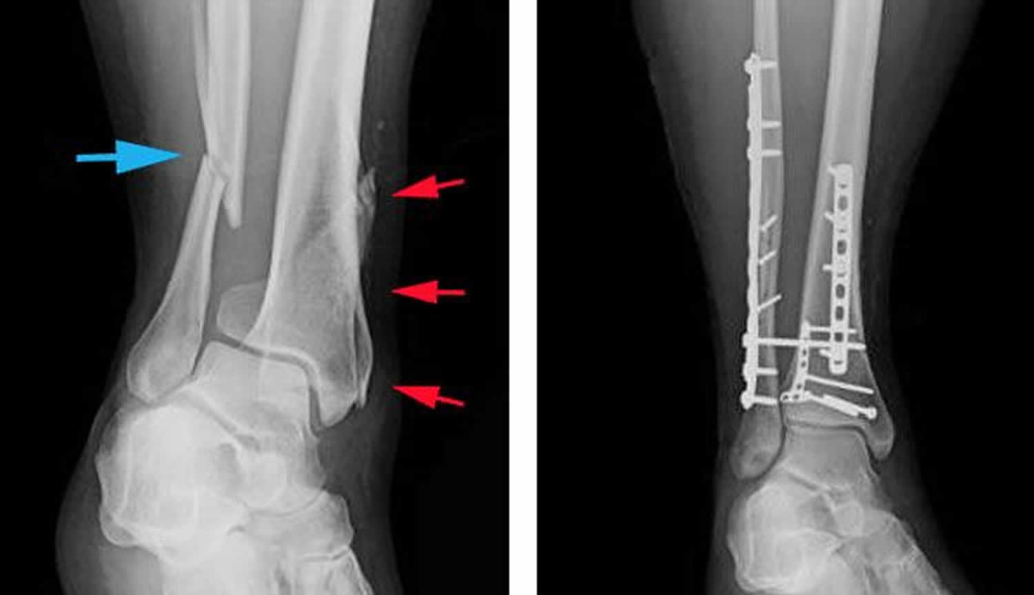 tibia compression fracture treatment