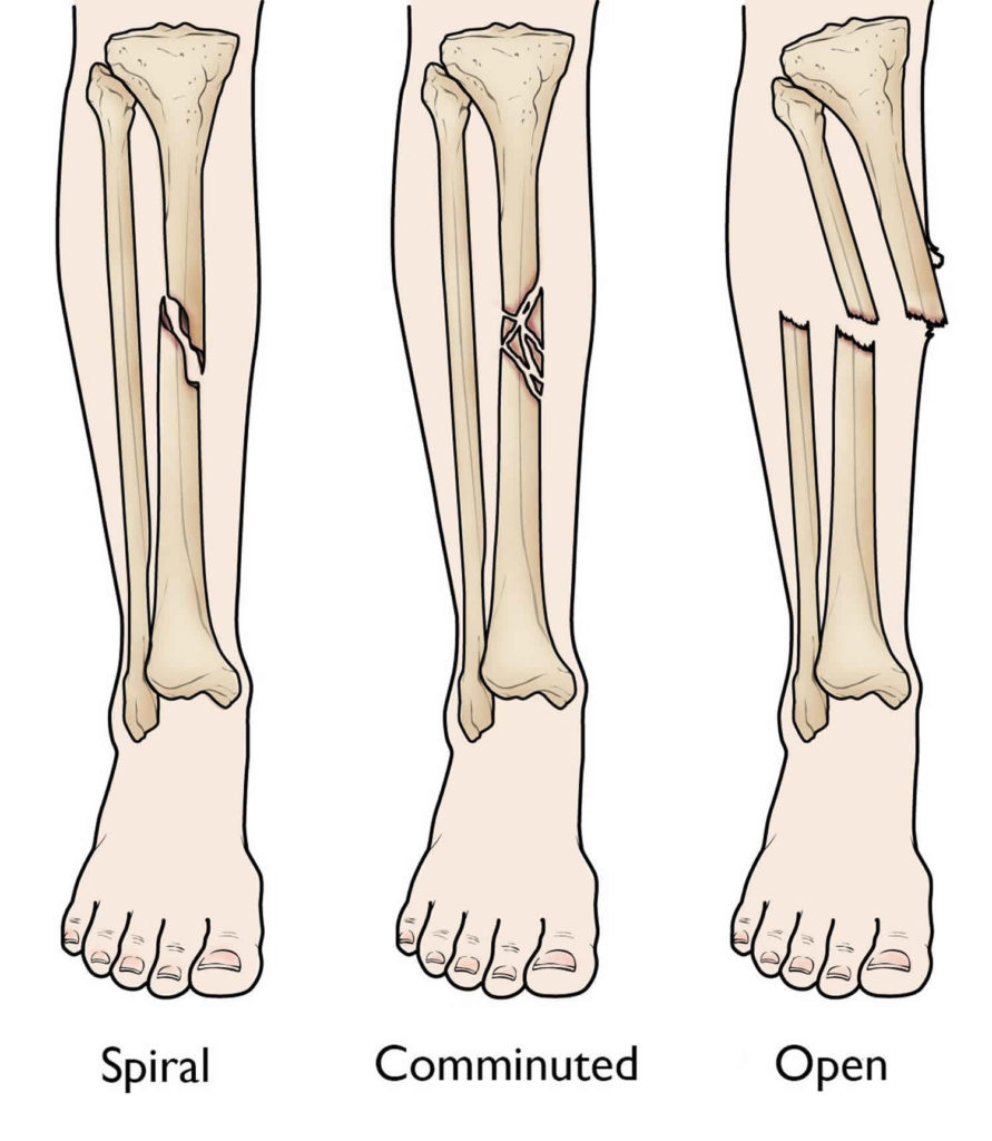Tibial shaft fracture causes, types, symptoms, diagnosis, treatment