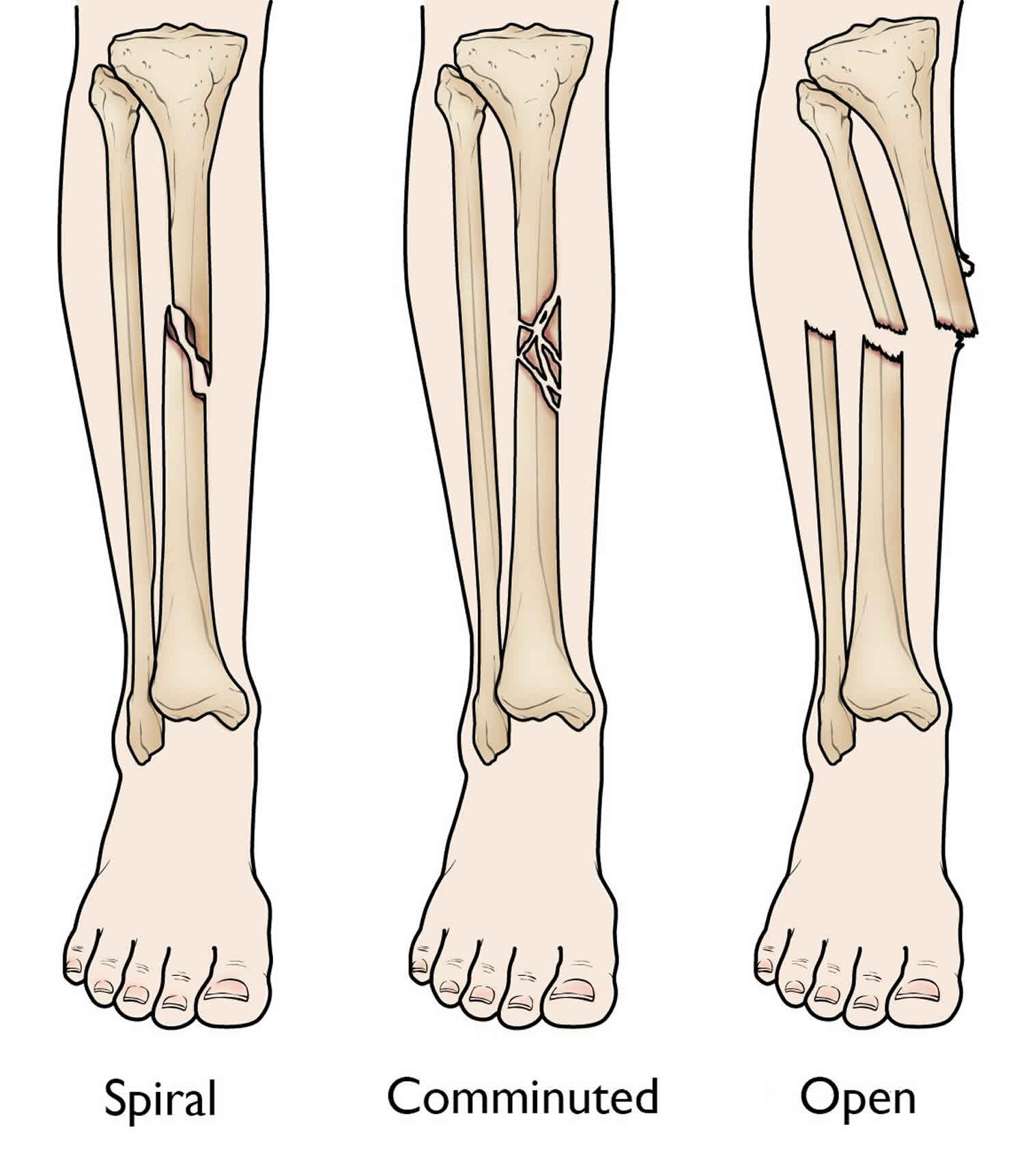 tibial-shaft-fracture-causes-types-symptoms-diagnosis-treatment