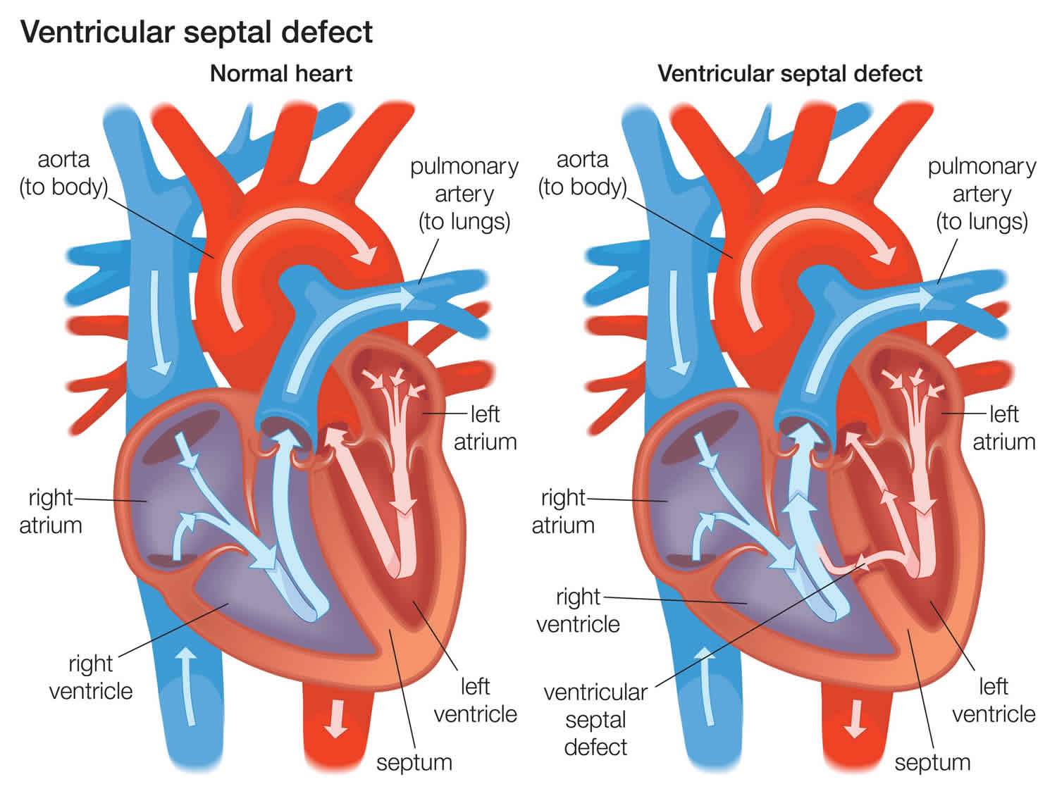 Ventricular septal defect causes, types, symptoms, diagnosis, treatment ...