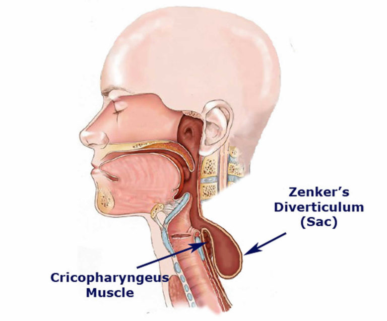 Zenker's diverticulum causes, symptoms, diagnosis & treatment