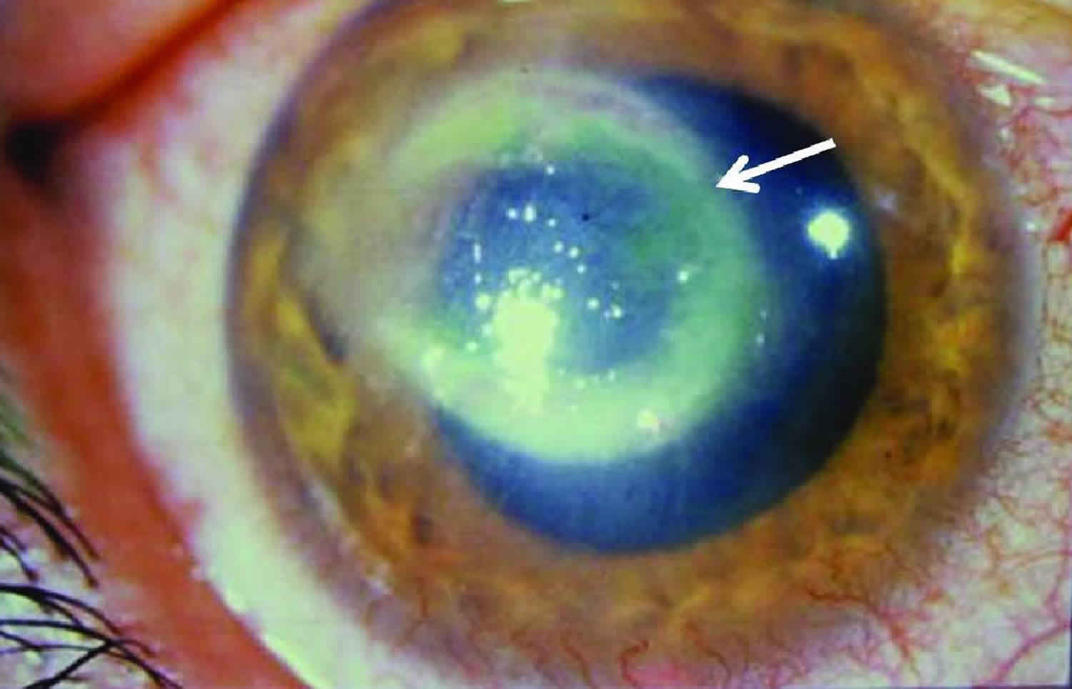 acanthamoeba corneal ulcer