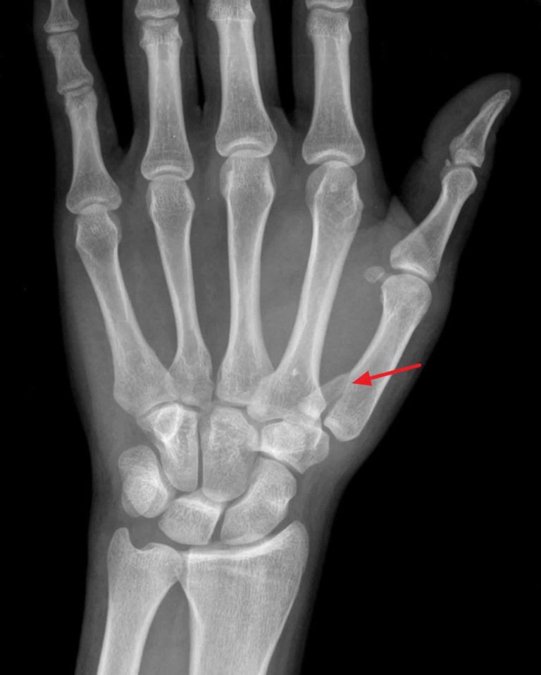 Bennett fracture causes, symptoms, diagnosis, treatment & prognosis