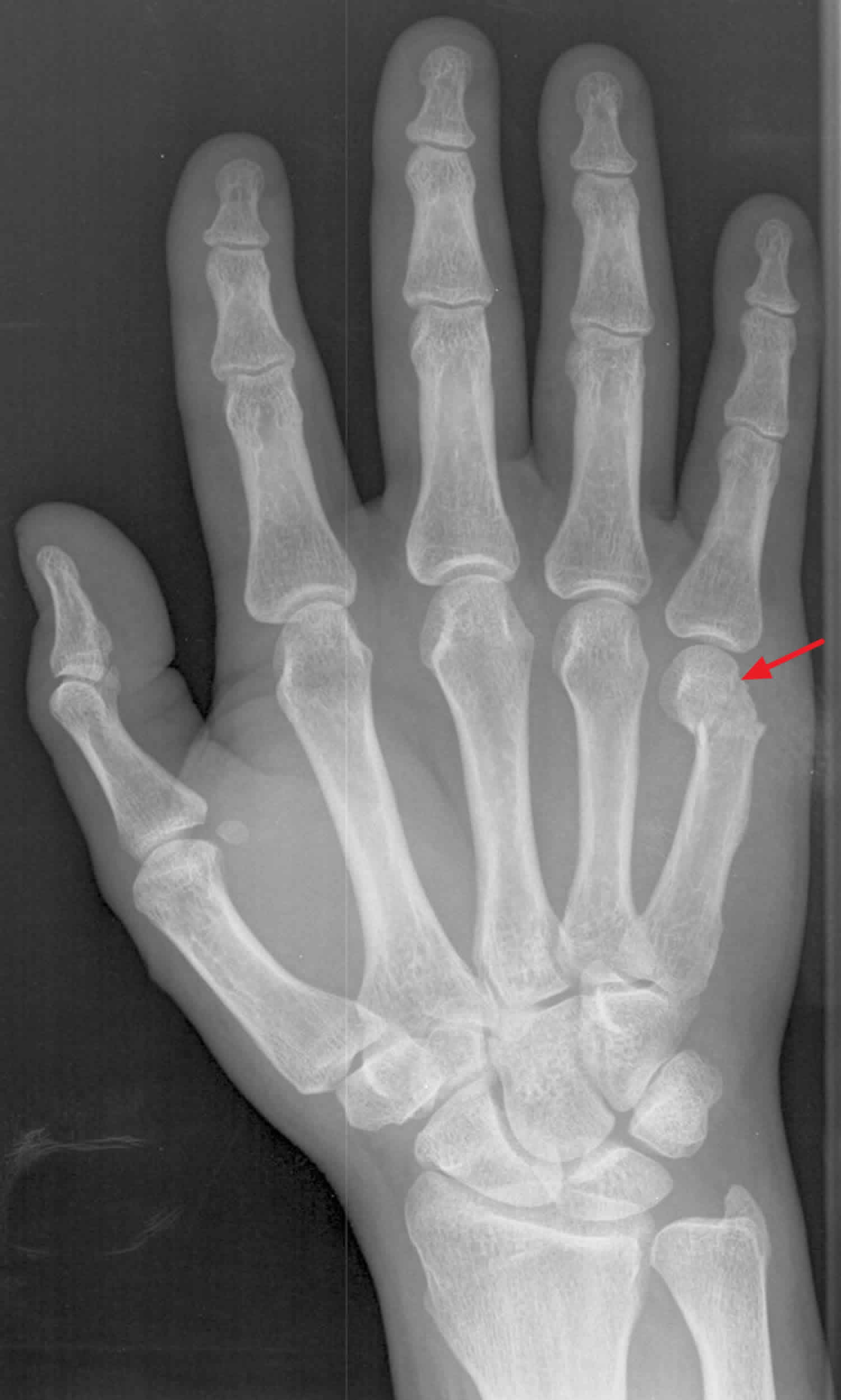 fifth metacarpal fracture treatment