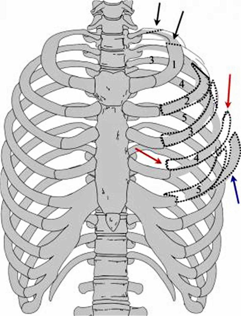 Flail chest definition, causes, symptoms, diagnosis, treatment & prognosis