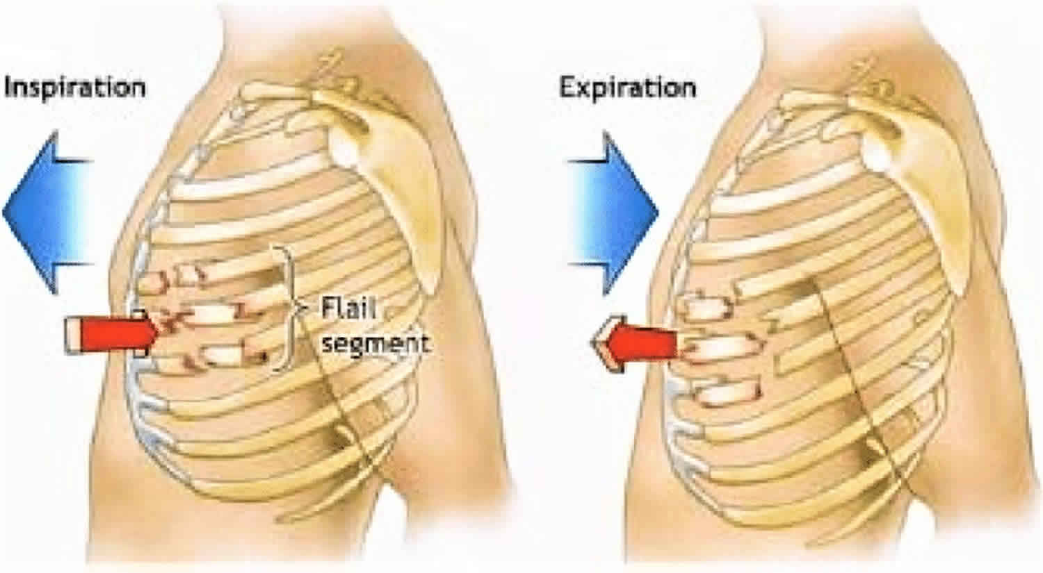 Flail Chest: Causes, Symptoms, Diagnosis & Treatment