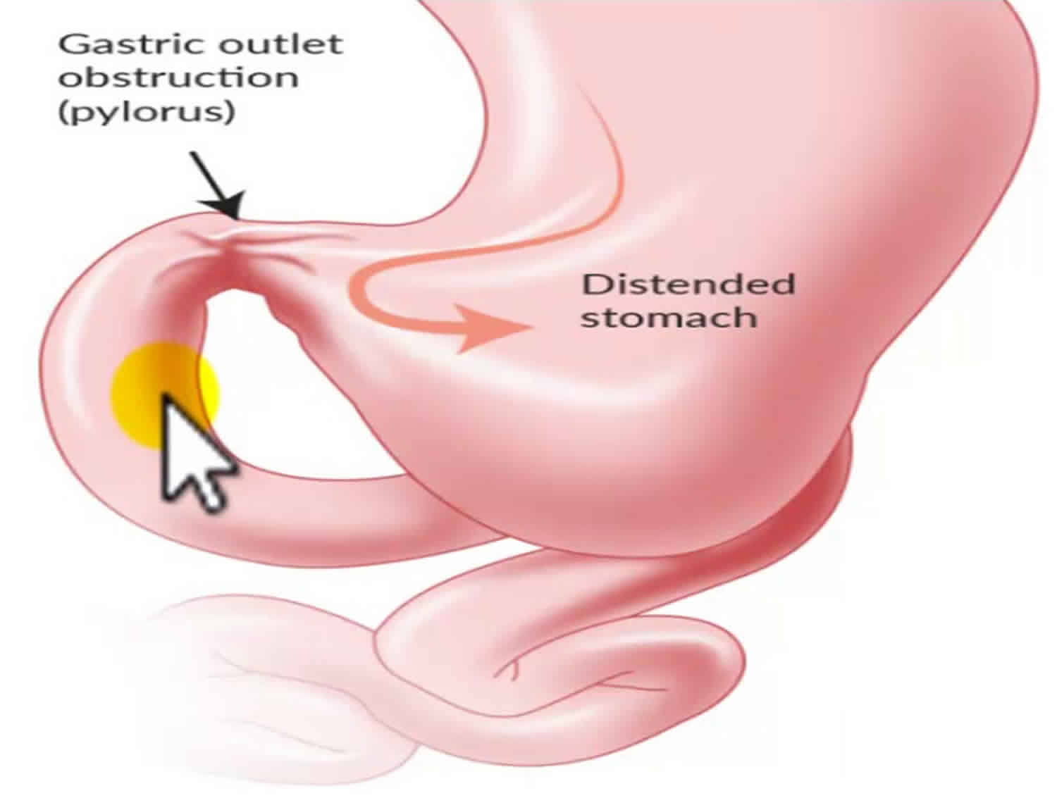 Vlad Herlea - Pancreatic cancer gastric outlet obstruction