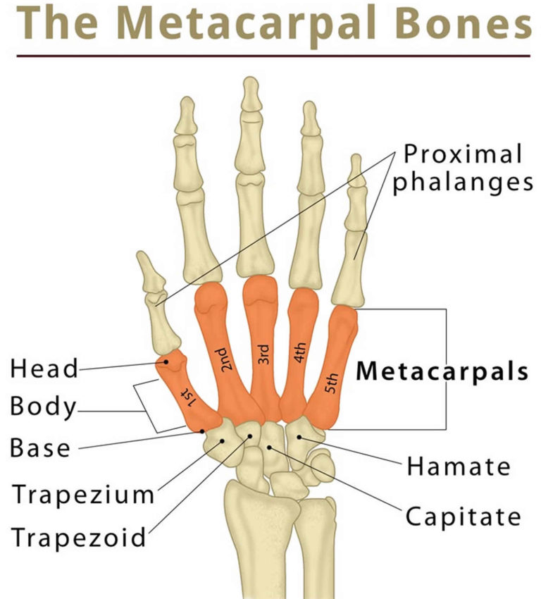 3rd metacarpal fracture splint