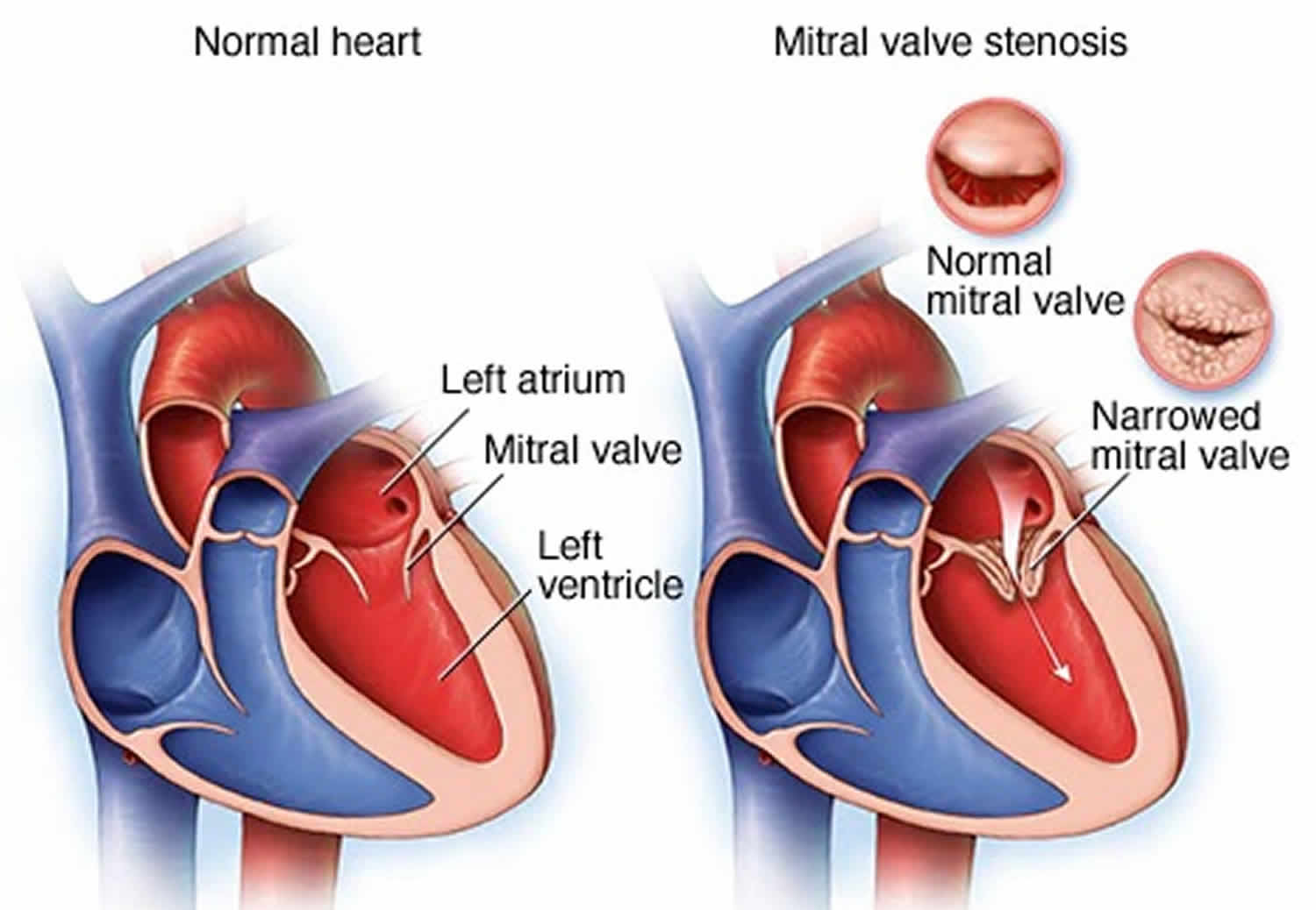 Is Mitral Valve Replacement Considered Heart Disease