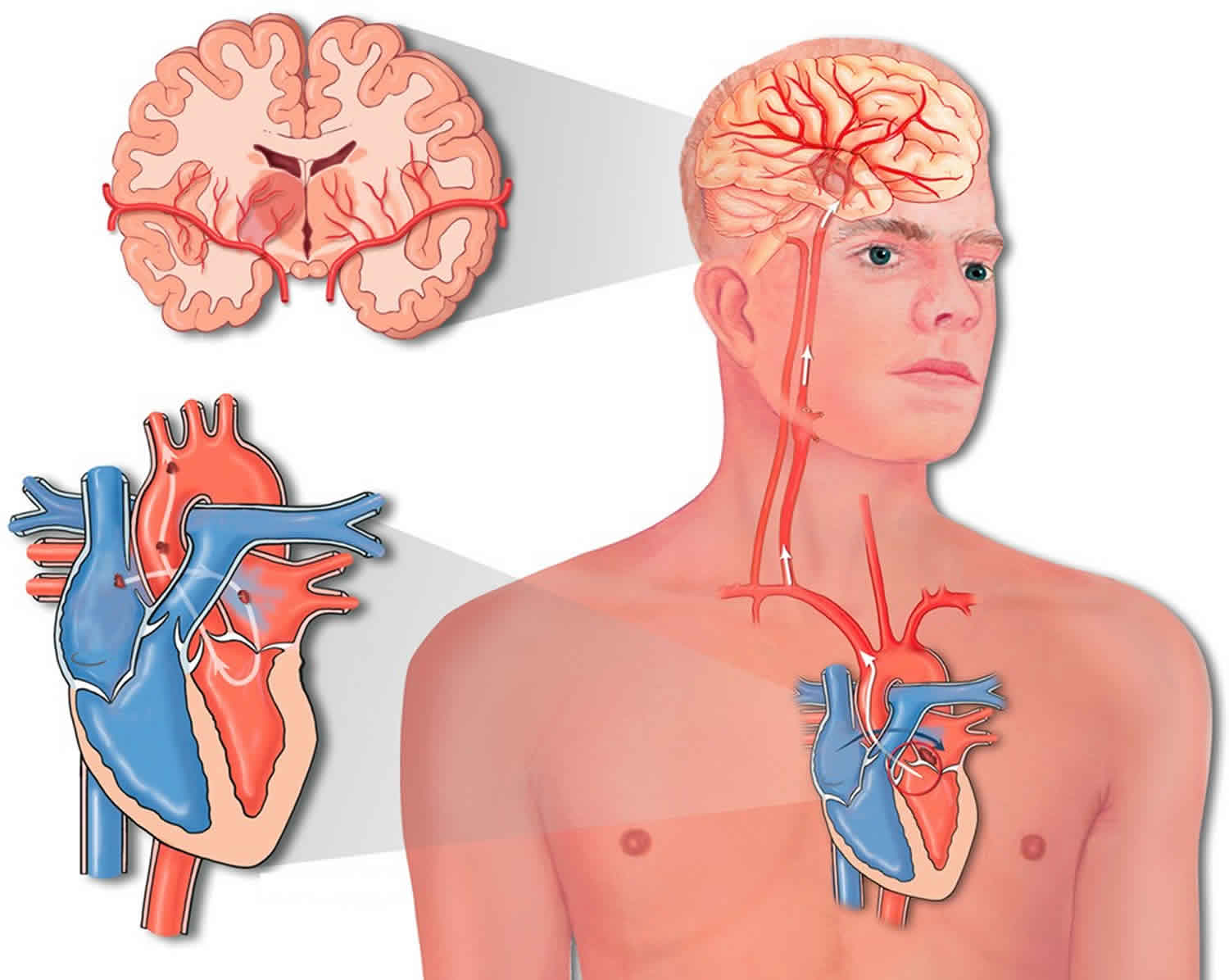 Инсульт картина. Гемодинамический ишемический инсульт. Ишемический инсульт иллюстрация. Инфаркт головного мозга и инсульт. Ишемический сердечный инсульт.