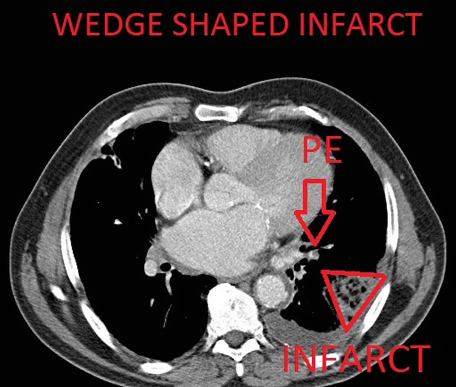 pulmonary-infarction-causes-symptoms-diagnosis-treatment