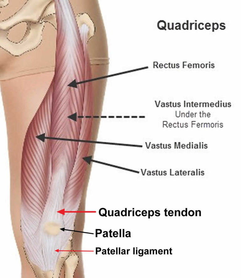 Ruptured Quadriceps Tendon Causes Symptoms Diagnosis Treatment Recovery