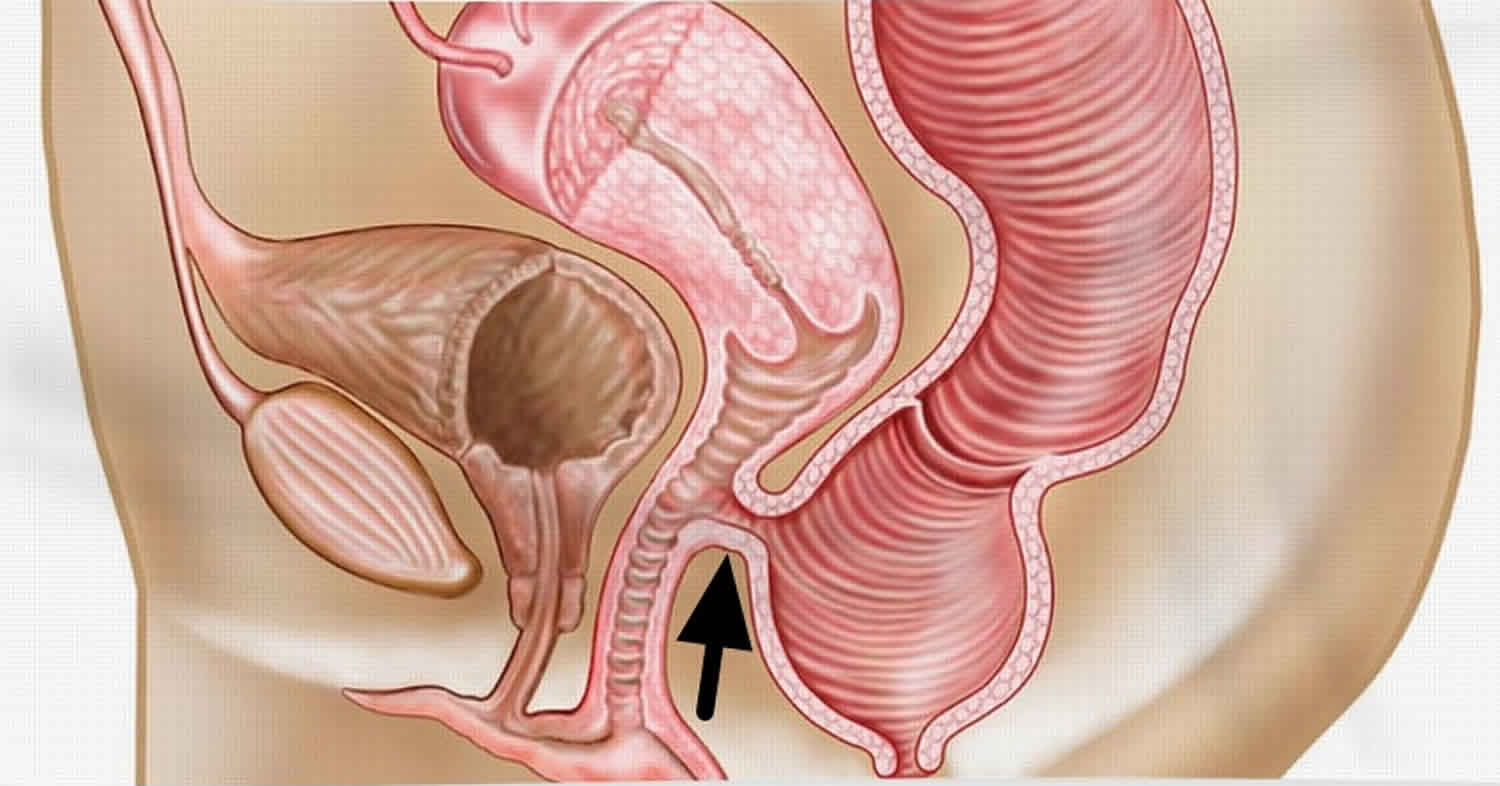 rectum vagina fistula gas self help