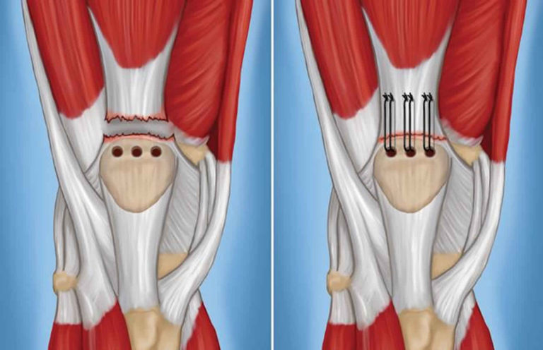 Ruptured quadriceps tendon causes, symptoms, diagnosis, treatment ...