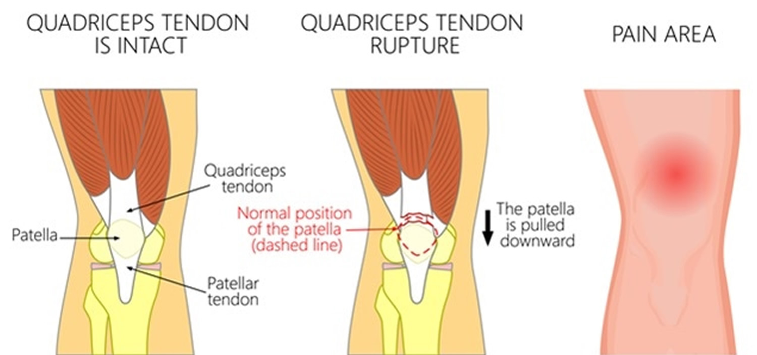 Ruptured Quadriceps Tendon Causes Symptoms Diagnosis 51 OFF